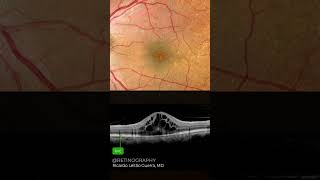 Cystoid macular edema [upl. by Lovett]