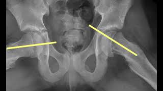 slipped femoral epiphysis [upl. by Eob]