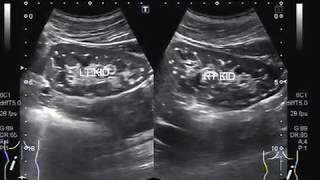 Ultrasound Video showing bilateral renal microlithiasis [upl. by Enawd97]