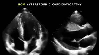 Hypertrophic Cardiomyopathy  HCM  Echo clip [upl. by Camile]