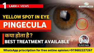 पिंगेकुला क्या होता है कारण लक्षण और उपचार  Pinguecula Causes Symptoms and Treatment [upl. by Ahsemot]