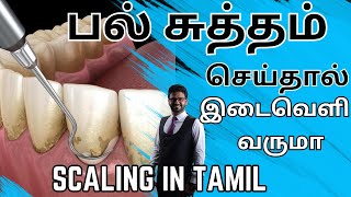 பல் சுத்தம்𝐬𝐜𝐚𝐥𝐢𝐧𝐠 செய்தால் இடைவெளி உண்டாகுமா𝐓𝐞𝐞𝐭𝐡 𝐜𝐥𝐞𝐚𝐧𝐢𝐧𝐠 𝐢𝐧 𝐭𝐚𝐦𝐢𝐥𝐬𝐜𝐚𝐥𝐢𝐧𝐠 𝐢𝐧 𝐭𝐚𝐦𝐢𝐥 [upl. by Gard621]