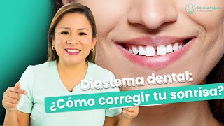 Diastema dental Como corregir tu sonrisa [upl. by Danieu]