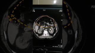 Hydronephrosis  Findings of kidney  Scan of kidney  Medical Imaging  CT Scan  Calculi of kidney [upl. by Anoit73]