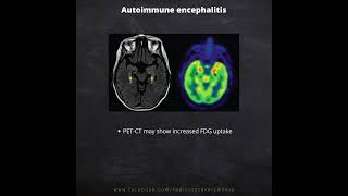 Autoimmune Encephalitis Radiological imaging [upl. by Thamos941]