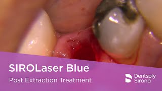 SIROLaser Blue  Post Extraction Treatment [upl. by Gord]