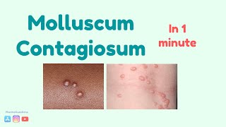 Molluscum Contagiosum Causes symptoms and treatment [upl. by Knut]