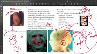 Oligohydramnios and Potter sequence [upl. by Ariat]