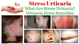 Stress Urticaria  What Are Stress Urticaria  Urticaria Home Remedies 😊😊 [upl. by Pozzy336]