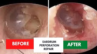 Successful repair of eardrum perforation [upl. by Anirav]