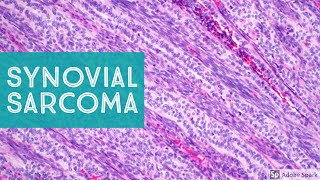 Synovial Sarcoma 101…Explained by a Soft Tissue Pathologist [upl. by Rob]