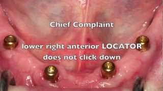 NEW Locator Dental Implant Attachments  Workshop Tips [upl. by Alix]