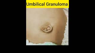 Umbilical Granuloma [upl. by Rozamond278]