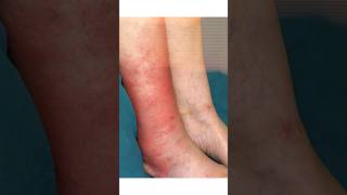 How to Treat Cellulitis mumbai shortsfeed2024 vascularhealth shortsvideo [upl. by Ledua]