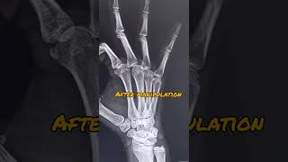 Dislocation pip joint🦴 anatomy manipulation ortho bones [upl. by Estell]