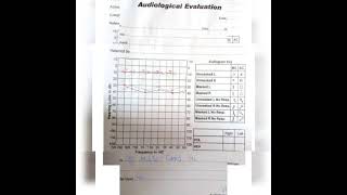 Audiological Evaluation Audiogram conductivemixed SNHL hearing Losstypes of Hearing Loss। [upl. by Anaila]