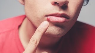 Dermatologist explains causes of cold sores [upl. by Elkraps]