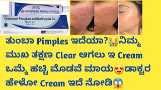 Nilac Cream Review in kannadaUsesside effectssafety Advice acneremoval pimplefree skincare [upl. by Hevak832]