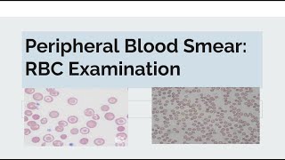 Peripheral Blood Smear Examination of RBC [upl. by Atteve]