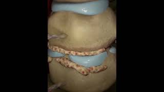 Cervical discectomy  animationshorts shortsfeed youtubeshorts viralshorts [upl. by Bez]