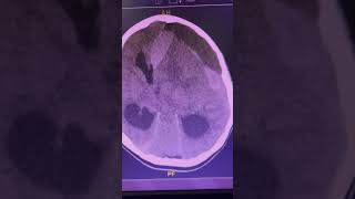 Who can interpret CT Brain study medicine subscribe if you want to learn more about this patient [upl. by Rycca]