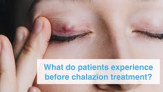 What do patients experience before chalazion treatment [upl. by Notrem]