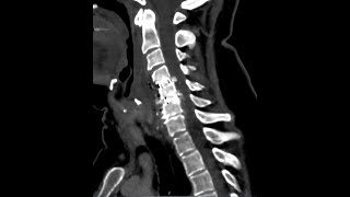 Postoperative neck abscess  cervical spine surgery complication [upl. by Karlie]