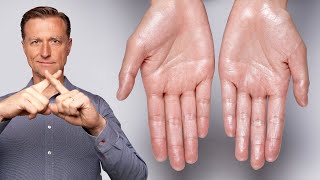 How to Stop Excessive Sweating Hyperhidrosis [upl. by Webster]