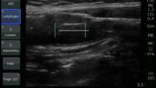 CIMT Exam  Performing Measurements  Sonosite [upl. by Aivekal503]