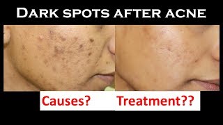 Dark spot after acne post inflammatory hyperpigmentation  causes amp treatment  dermatologist [upl. by Modestia]