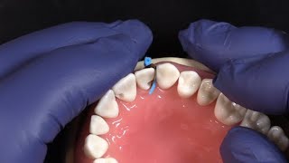 NEW Fusion Anterior Matrix System from Garrison Dental Solutions [upl. by Icak]