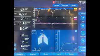 Endinspiratory Occlusion Maneuver and Pmus [upl. by Sdlonyer]