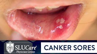 Determining Causes amp Treatment for Canker Sores  SLUCare Otolaryngology [upl. by Micaela]