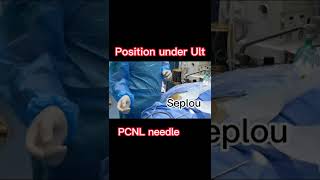 Percutaneous nephrolithotomy PCNL minimally invasive keyhole procedure to remove kidney stones [upl. by Tannie]