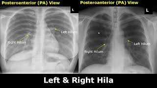 Normal Chest XRay Labelled Anatomy PA View Part 1 CXR Interpretation RibsHeartLungs Radiography [upl. by Arsi]