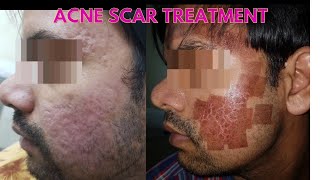 Laser acne scar removal  Before and after results  Laser treatment for scars [upl. by Edualcnaej]