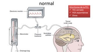 Hipertensión Endocraneana  FISIOPATOLOGIA  GRUPO ATLAS [upl. by Atiruam]