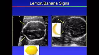 Fetal Congenital anomalies part 1 [upl. by Notloc474]