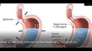 Living a Normal Life Post Gastrectomy [upl. by Lerrej201]