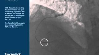 Casos Complexos de CTO  Turnpike  Line Life Cardiovascular [upl. by Ahsemed]