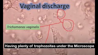 Trichomonas pus cells epithelial cells RBCs in vaginal swab microscopy [upl. by Letsyrc]