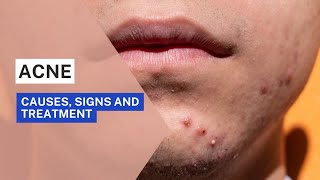 Acne  Causes signs and treatment [upl. by Sergius]