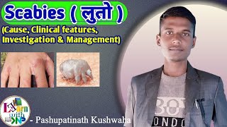 Scabies  लुतो   Skin disease  Treatment of scabies  healthloksewa scabies [upl. by Ellwood]