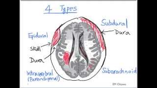 Intracranial Bleed  Part 1 [upl. by Marget]