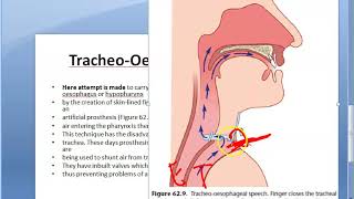 ENT 368 a Tracheo Esophageal speech Voice Rehabilitation after Laryngectomy total TEP hole neck [upl. by Nauqaj]