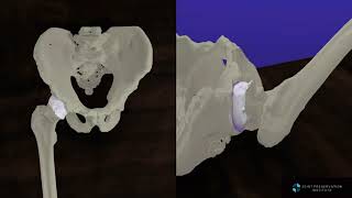 Three Dimensional Femoroacetabular Impingement Animation [upl. by Germano652]