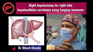 Right hepatectomy for right lobe hepatocellular carcinima using hanging maneuver  Dr Hitesh Chavda [upl. by Annehsat726]