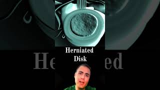 Herniated Disc [upl. by Llerraj]