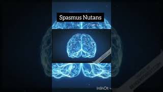 Spasmus Nutans [upl. by Yehc]