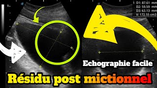 Evaluation du résidu post mictionnel en échographie [upl. by Jona]